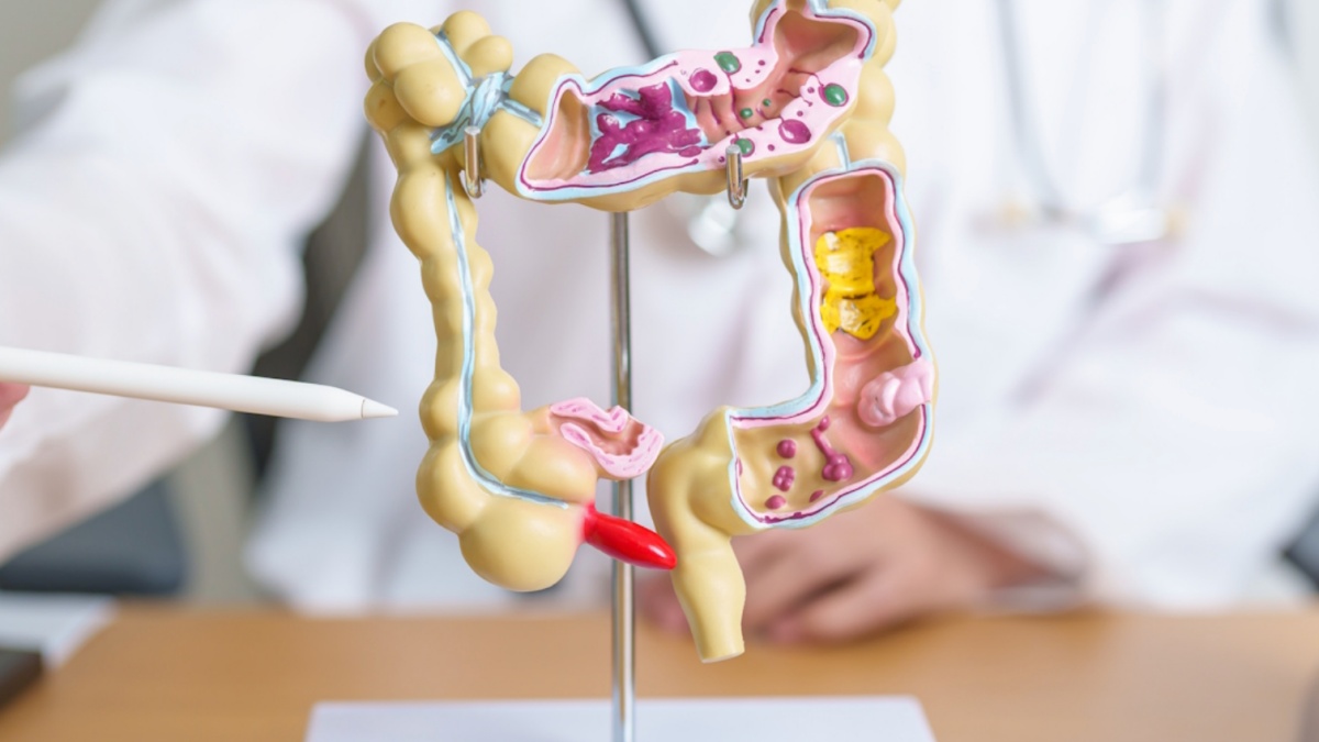 I 5 sintomi del tumore al colon da non ignorare, secondo gli esperti