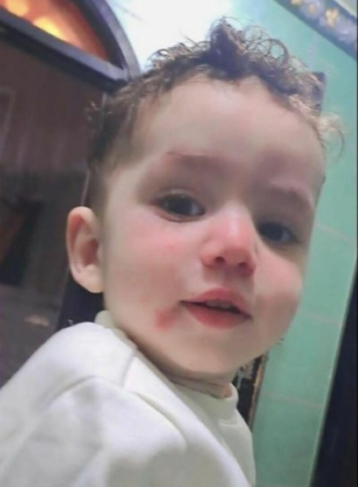 bambino 2 anni morto operazione