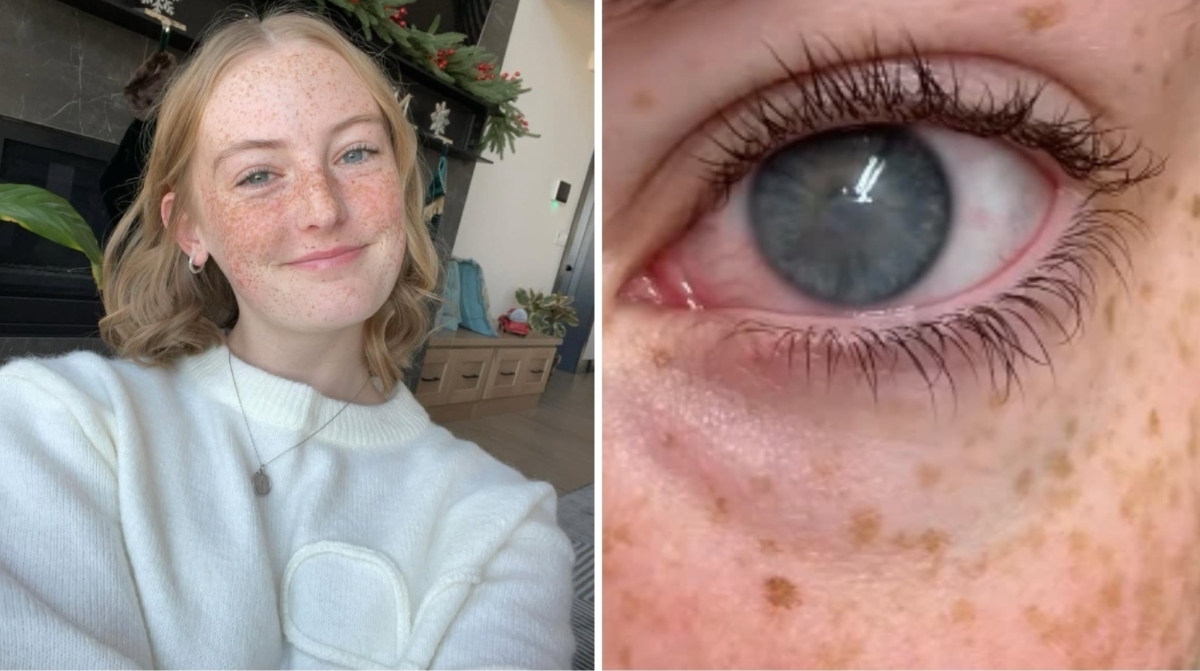 Perdita della vista dopo la doccia: un caso sconvolgente