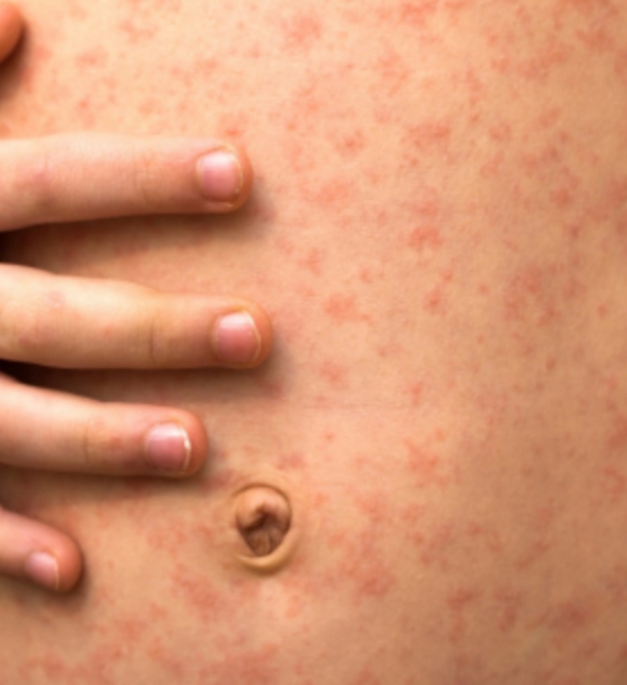 Morbillo sotto controllo con vaccini